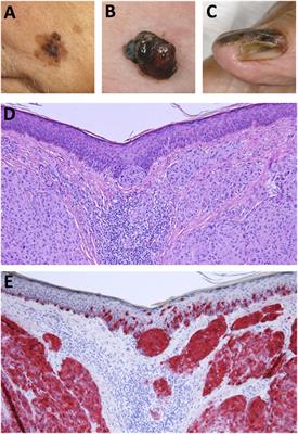 Recent Successes and Future Directions in Immunotherapy of Cutaneous Melanoma